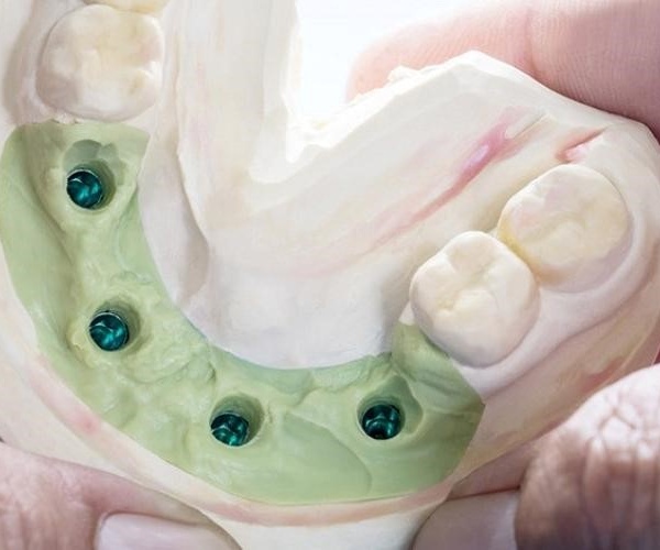 Nha Khoa Quốc Tế Sài Gòn Gắn abutment để lấy dấu chính xác