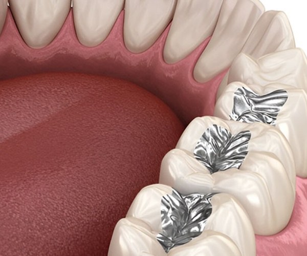 Nha Khoa Quốc Tế Sài Gòn Thực hiện test dị ứng với Titanium