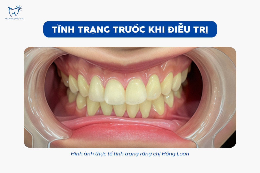 Nha Khoa Quốc Tế Sài Gòn Tình trạng răng trước khi tiến hành gắn răng sứ