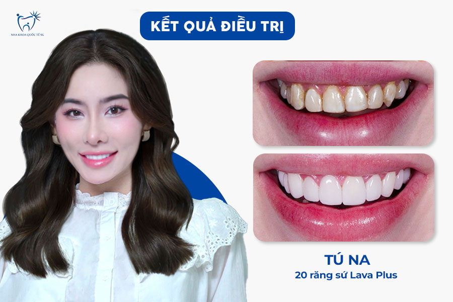 Nha Khoa Quốc Tế Sài Gòn Hình ảnh thay đổi hoàn toàn sau khi làm răng sứ thẩm mỹ