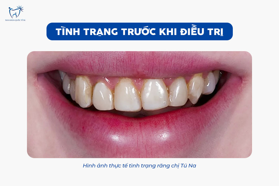 Nha Khoa Quốc Tế Sài Gòn Tình trạng răng chị Tú Na trước khi thực hiện dịch vụ răng sứ