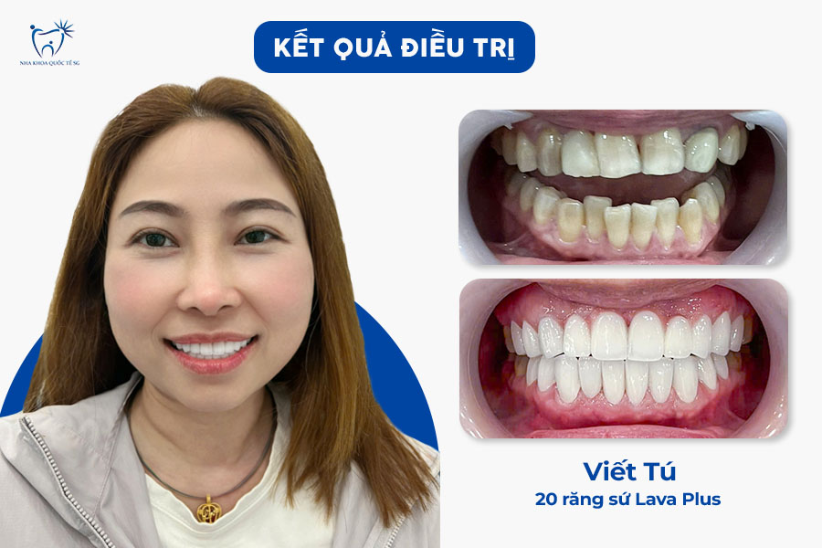 Nha Khoa Quốc Tế Sài Gòn Kết quả khi thực hiện làm thẩm mỹ răng sứ Lava Plus