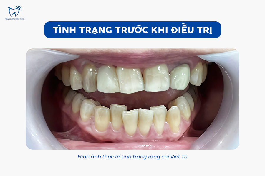 Nha Khoa Quốc Tế Sài Gòn Tình trạng răng trước khi điều trị khấp khểnh, không đều màu