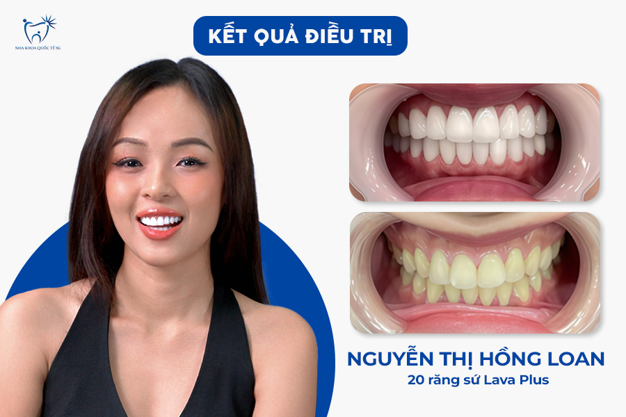 Nha Khoa Quốc Tế Sài Gòn Sự thay đổi rõ rệt sau khi gắn răng sứ thẩm mỹ