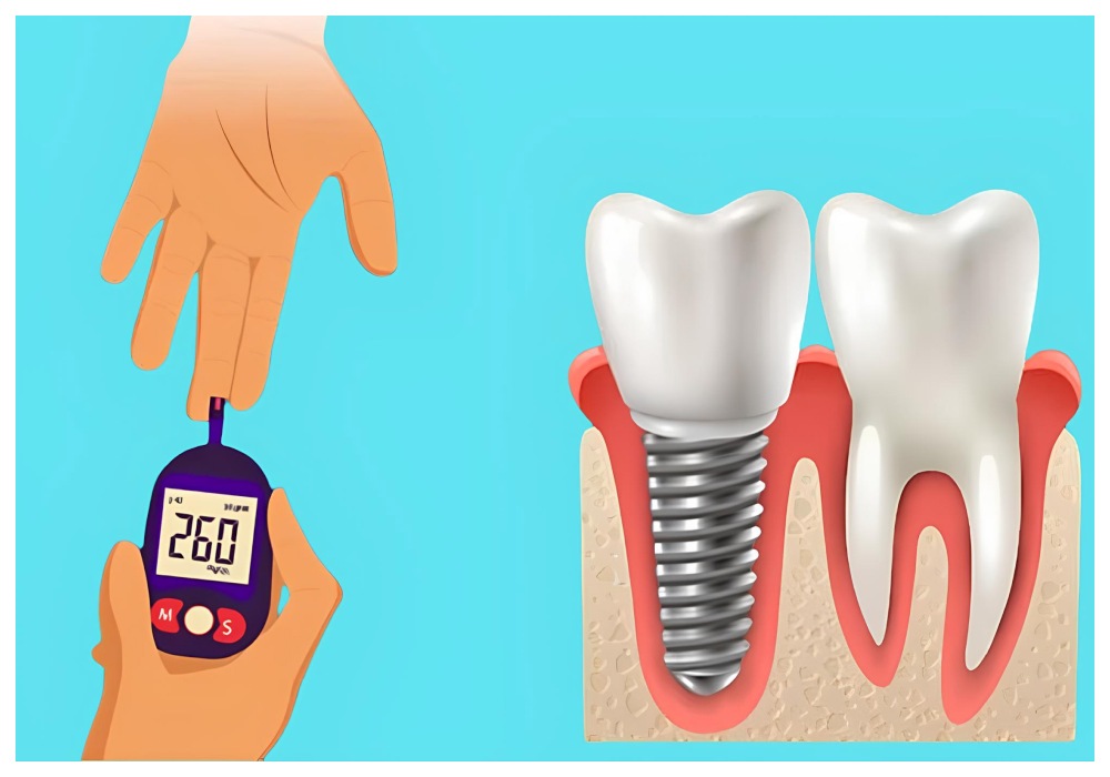 Nha Khoa Quốc Tế Sài Gòn Kiểm tra đường huyết trước khi trồng răng Implant