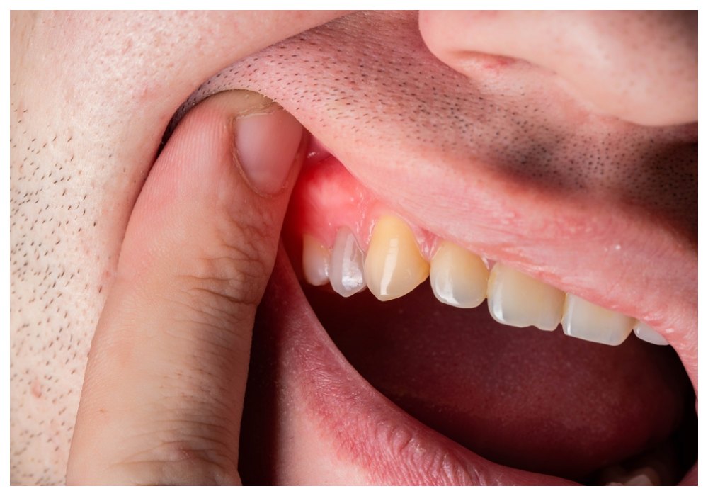 Nha Khoa Quốc Tế Sài Gòn Dấu hiệu sưng đỏ sau implant hoàn toàn là phản ứng bình thường của cơ thể