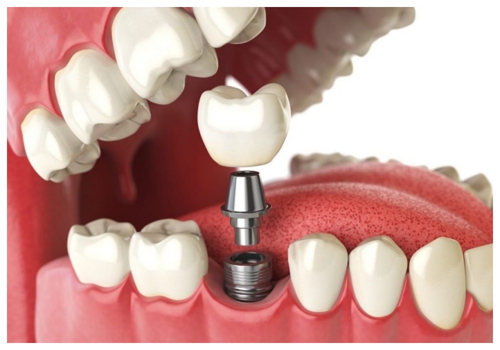 Nha Khoa Quốc Tế Sài Gòn Cắm Implant vào răng