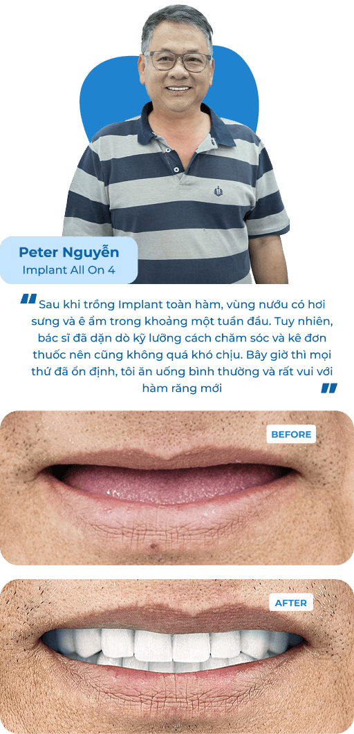 Dental Implant Case 1