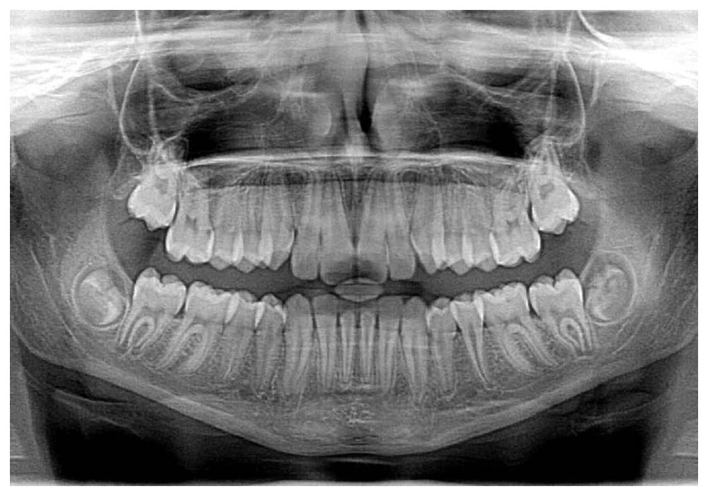 Nha Khoa Quốc Tế Sài Gòn Ảnh chụp X-quang cho thấy xương hàm đã phát triển hoàn thiện