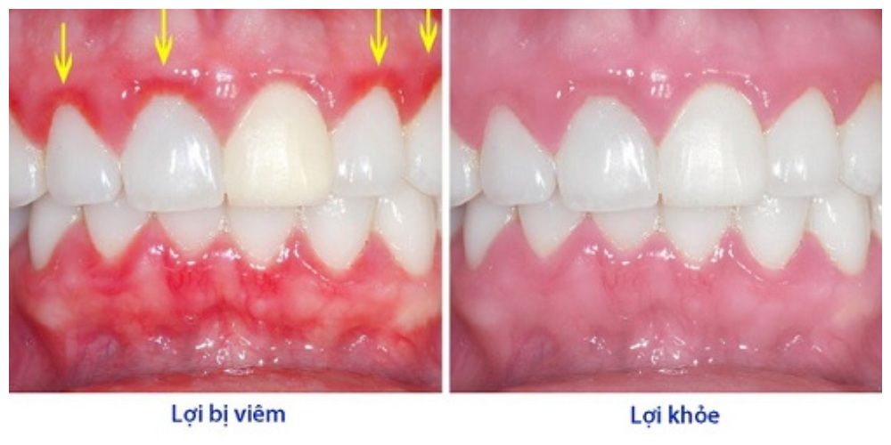 Nha Khoa Quốc Tế Sài Gòn Tình trạng nha chu khoẻ mạnh, không viêm nhiễm