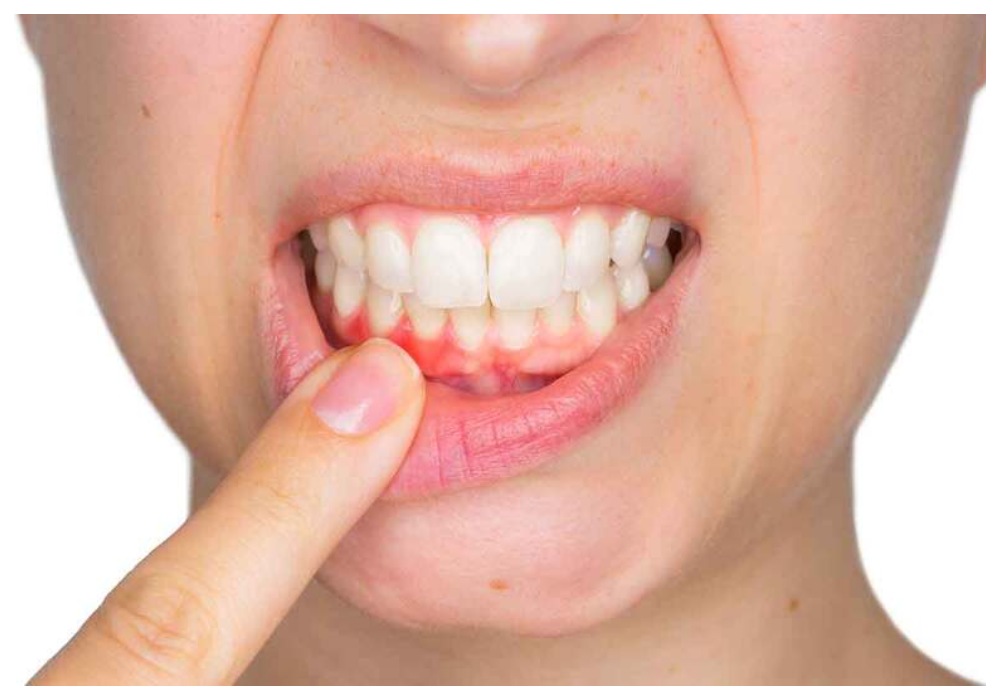 Nha Khoa Quốc Tế Sài Gòn Độ dày mô mềm xung quanh implant nên đạt tối thiểu 2mm