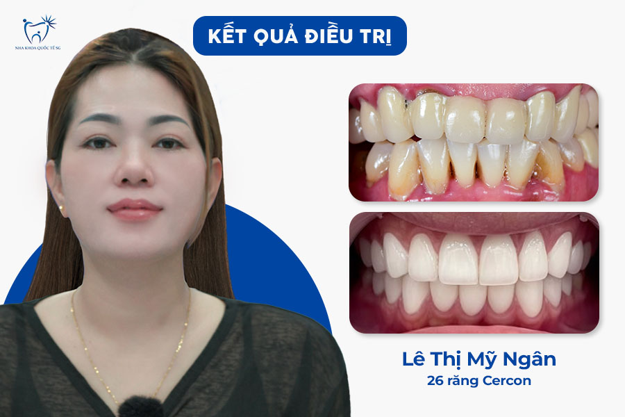 Nha Khoa Quốc Tế Sài Gòn Kết quả thực tế của chị Ngân sau khi gắn răng sứ Cercon