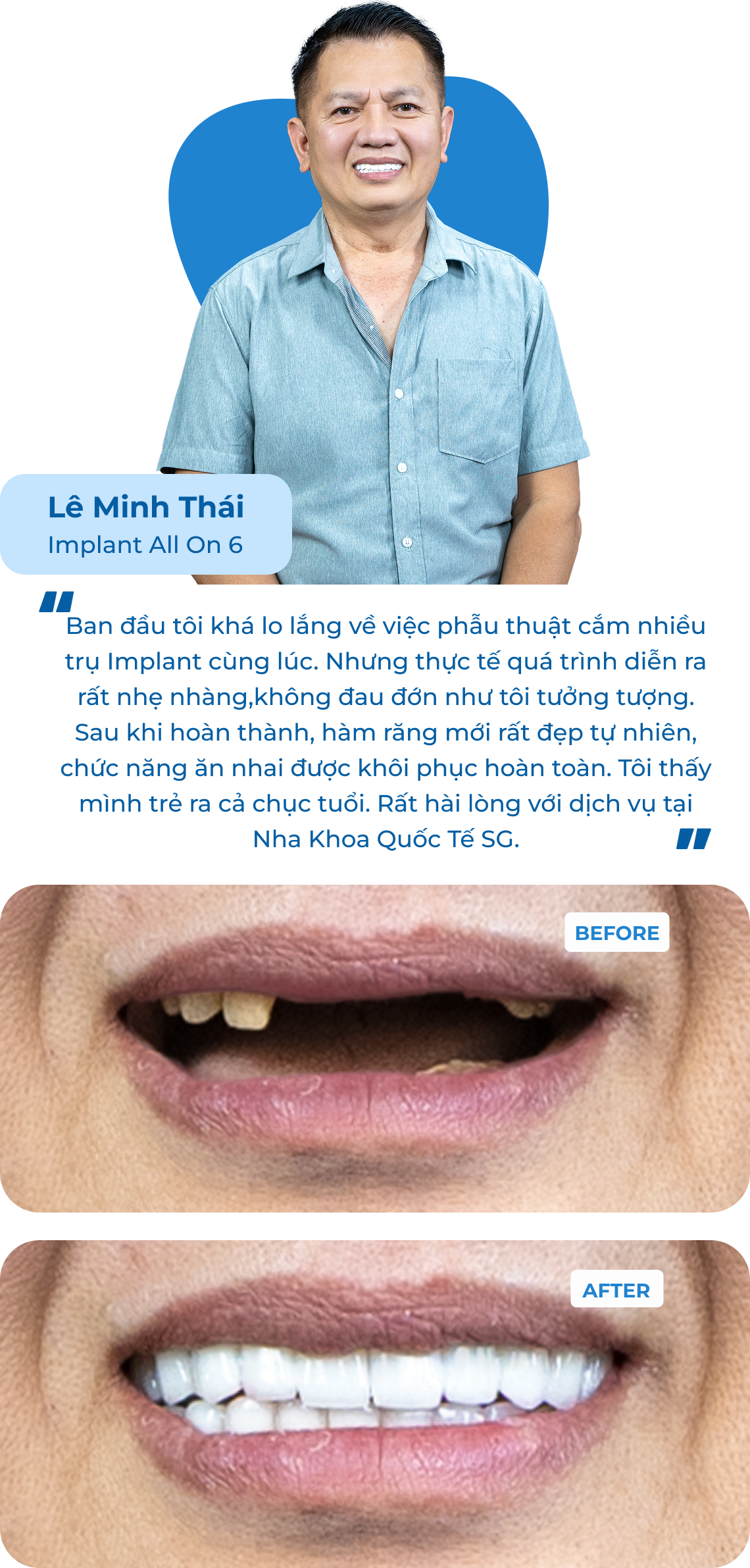 Dental Implant Case 2