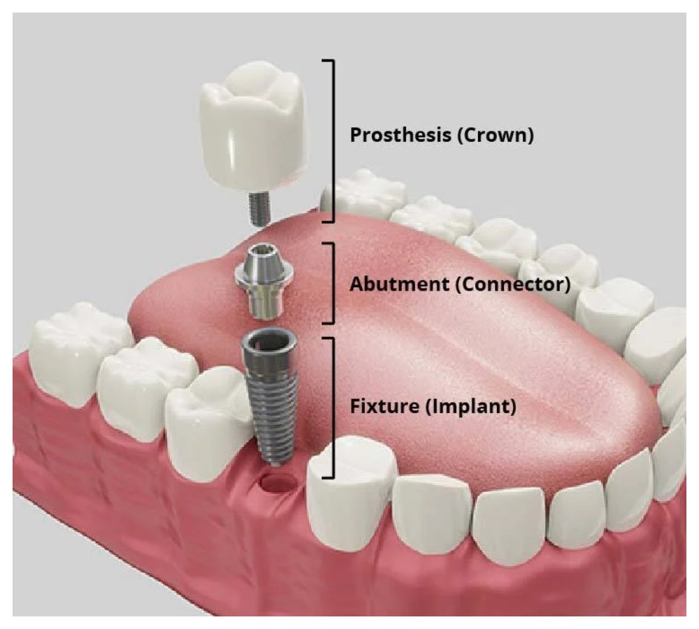 Nha Khoa Quốc Tế Sài Gòn Các thành phần cấu tạo nên trụ implant hoàn chỉnh