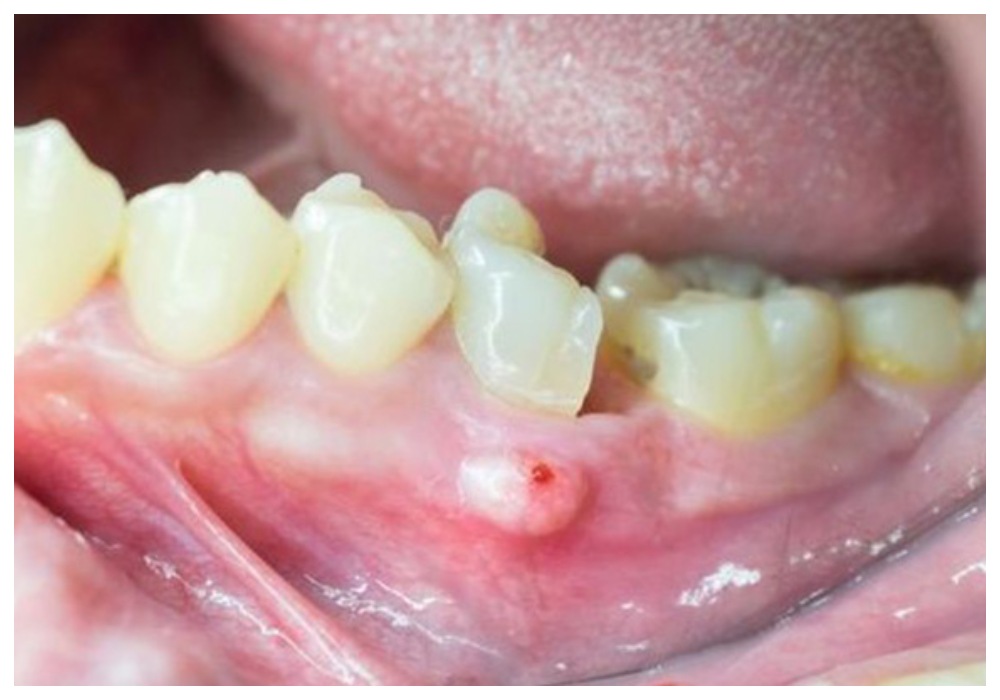 Nha Khoa Quốc Tế Sài Gòn Vùng đặt trụ Implant bị viêm nhiễm vì không duy trì vệ sinh răng miệng tốt