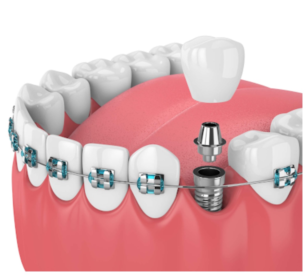 Nha Khoa Quốc Tế Sài Gòn Niềng răng khi cấy ghép Implant