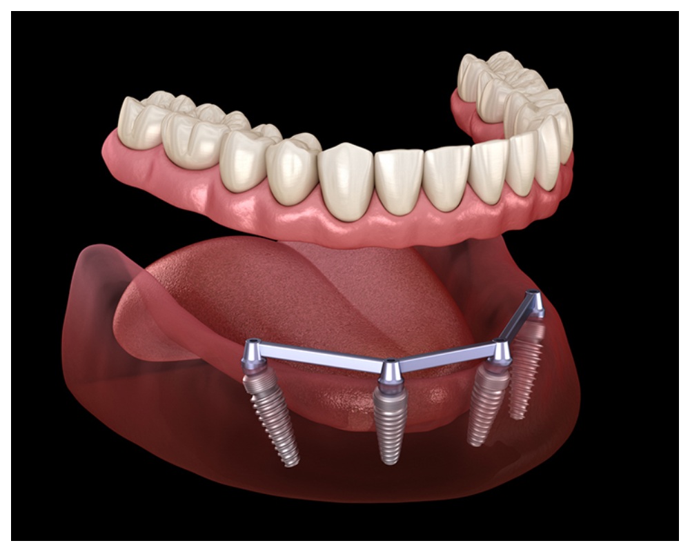 Nha Khoa Quốc Tế Sài Gòn Nếu đã trồng răng Implant toàn hàm thì không thể niềng răng