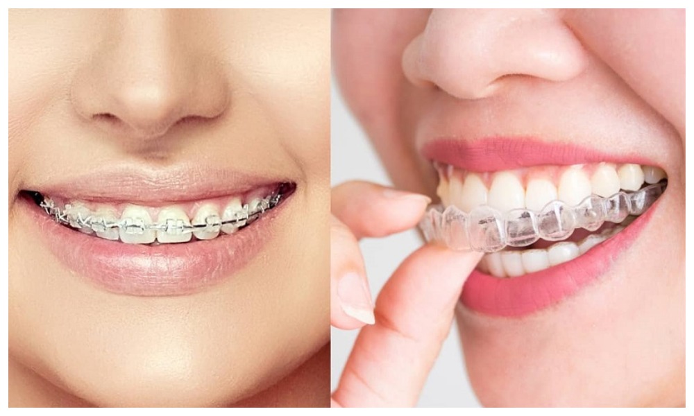 Nha Khoa Quốc Tế Sài Gòn Phương pháp niềng răng sau khi cấy Implant