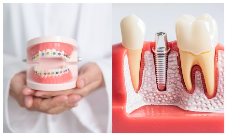 Khoảng sau 2 tuần khi trụ implant ổn định có thể tiến hành niềng răng