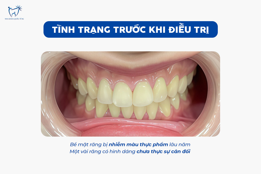 Nha Khoa Quốc Tế Sài Gòn Tình trạng răng trước khi tiến hành gắn răng sứ