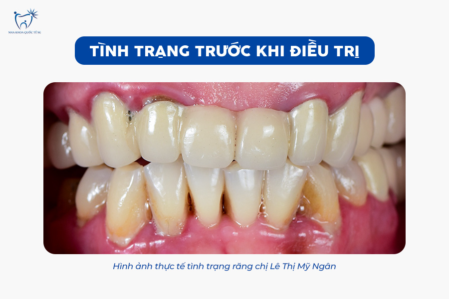 Nha Khoa Quốc Tế Sài Gòn Tình trạng răng thực tế trước khi thực hiện răng sứ thẩm mỹ