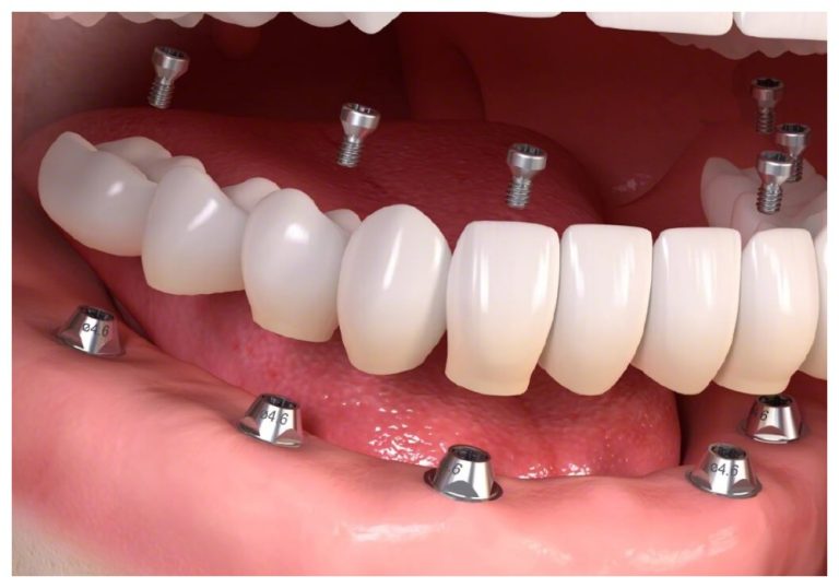 Mất nhiều răng cắn gần nhau sẽ sử dụng phương pháp cấy ghép Implant toàn hàm