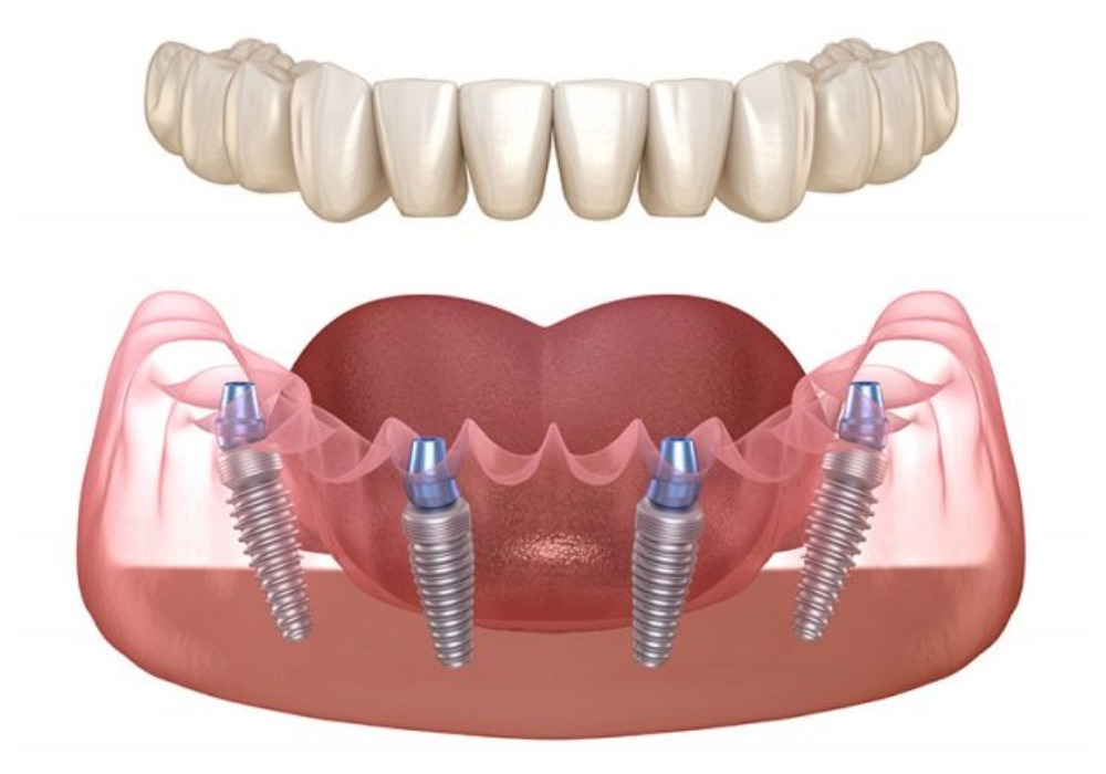 Nha Khoa Quốc Tế Sài Gòn Chi phí trồng răng sẽ phụ thuộc vào phương án điều trị