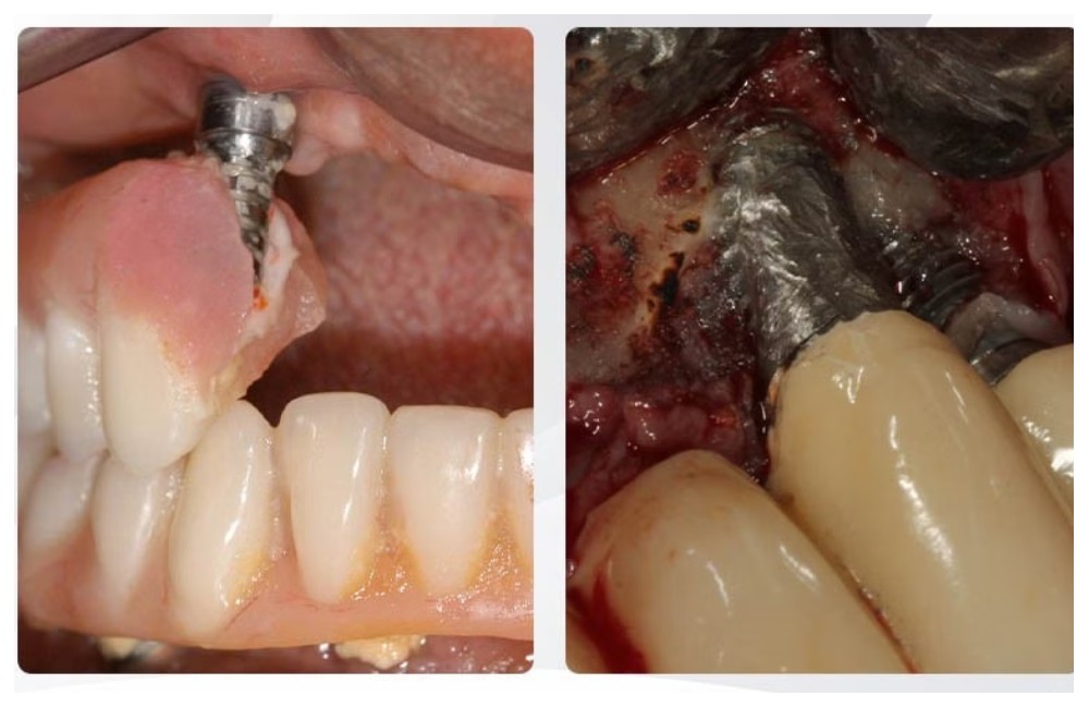 Nha Khoa Quốc Tế Sài Gòn Trụ Implant không rõ nguồn gốc dẫn đến đào thảo trụ Implant
