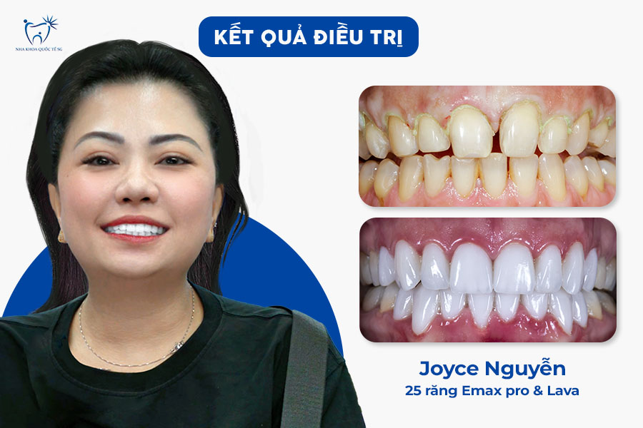 Nha Khoa Quốc Tế Sài Gòn Kết quả sau khi làm thẩm mỹ răng sứ tại Nha Khoa Quốc Tế SG