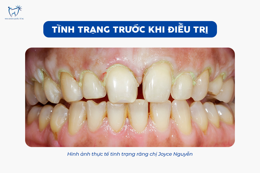 Nha Khoa Quốc Tế Sài Gòn Tình trạng răng trước khi làm thẩm mỹ răng sứ