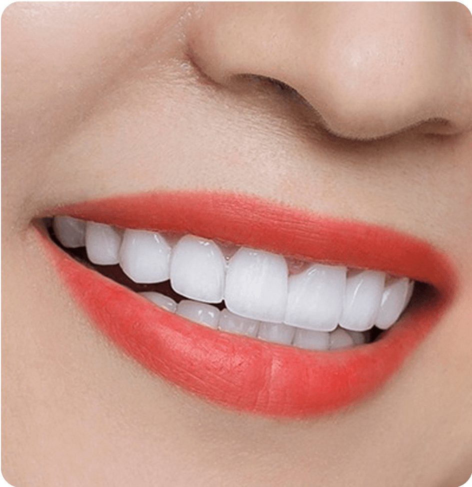 Tiến hành phục hình răng sứ cố định