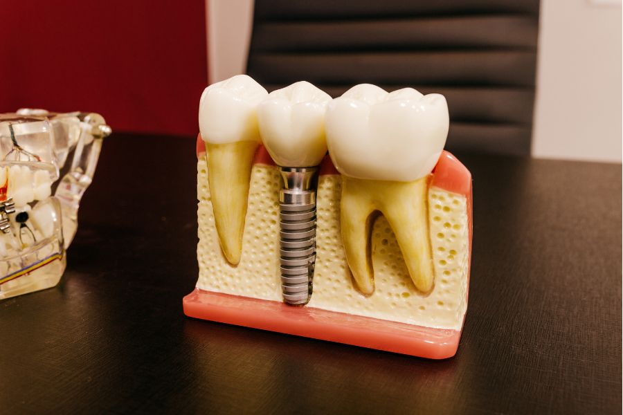 Nha Khoa Quốc Tế Sài Gòn Mô hình thực tế khi cấy trụ Implant vào hàm răng