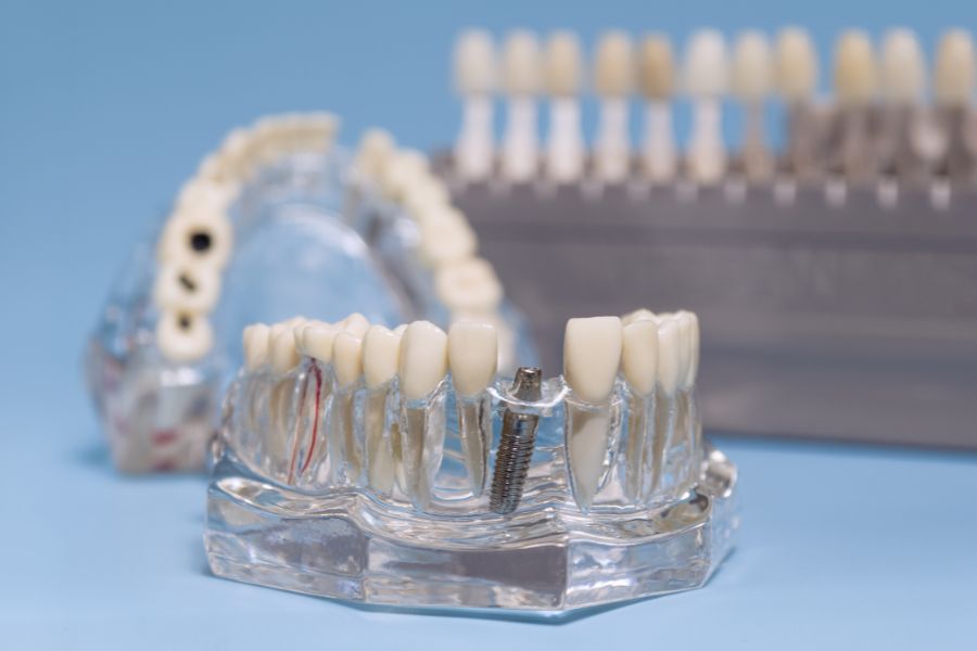 Nha Khoa Quốc Tế Sài Gòn Cấy trụ Implant là phương pháp tiên tiến nhất hiện nay