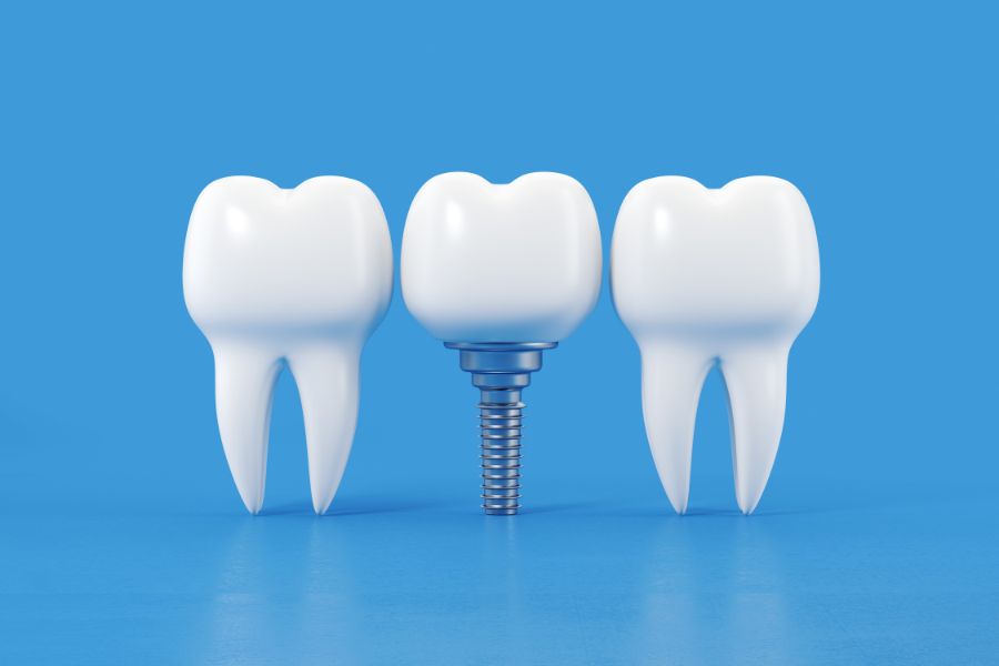 Nha Khoa Quốc Tế Sài Gòn Cấy trụ Implant không ảnh hưởng răng kế cận