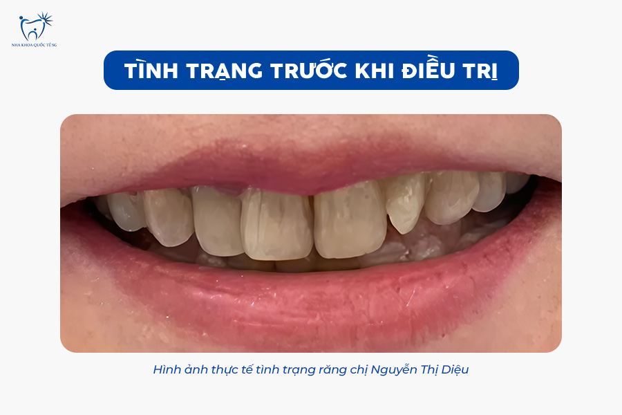 Nha Khoa Quốc Tế Sài Gòn Hình ảnh trước khi làm răng sứ thẩm mỹ