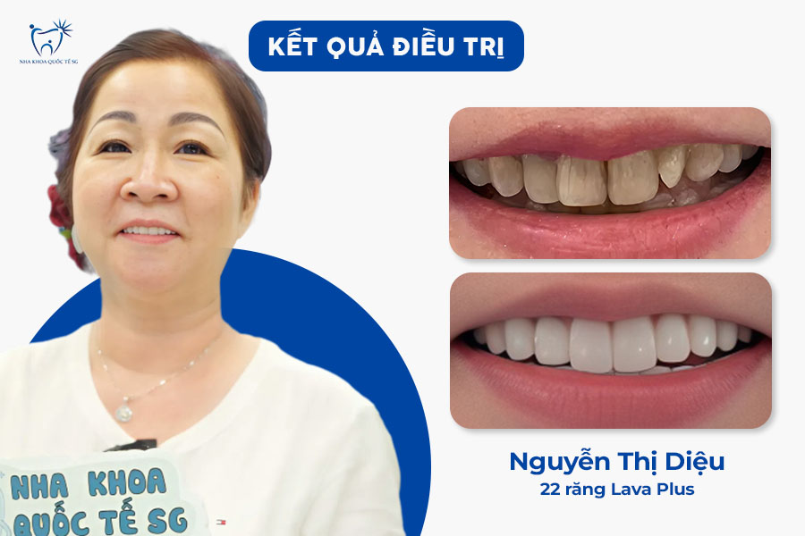 Nha Khoa Quốc Tế Sài Gòn Kết quả sau khi làm răng sứ thẩm mỹ của chị Diệu