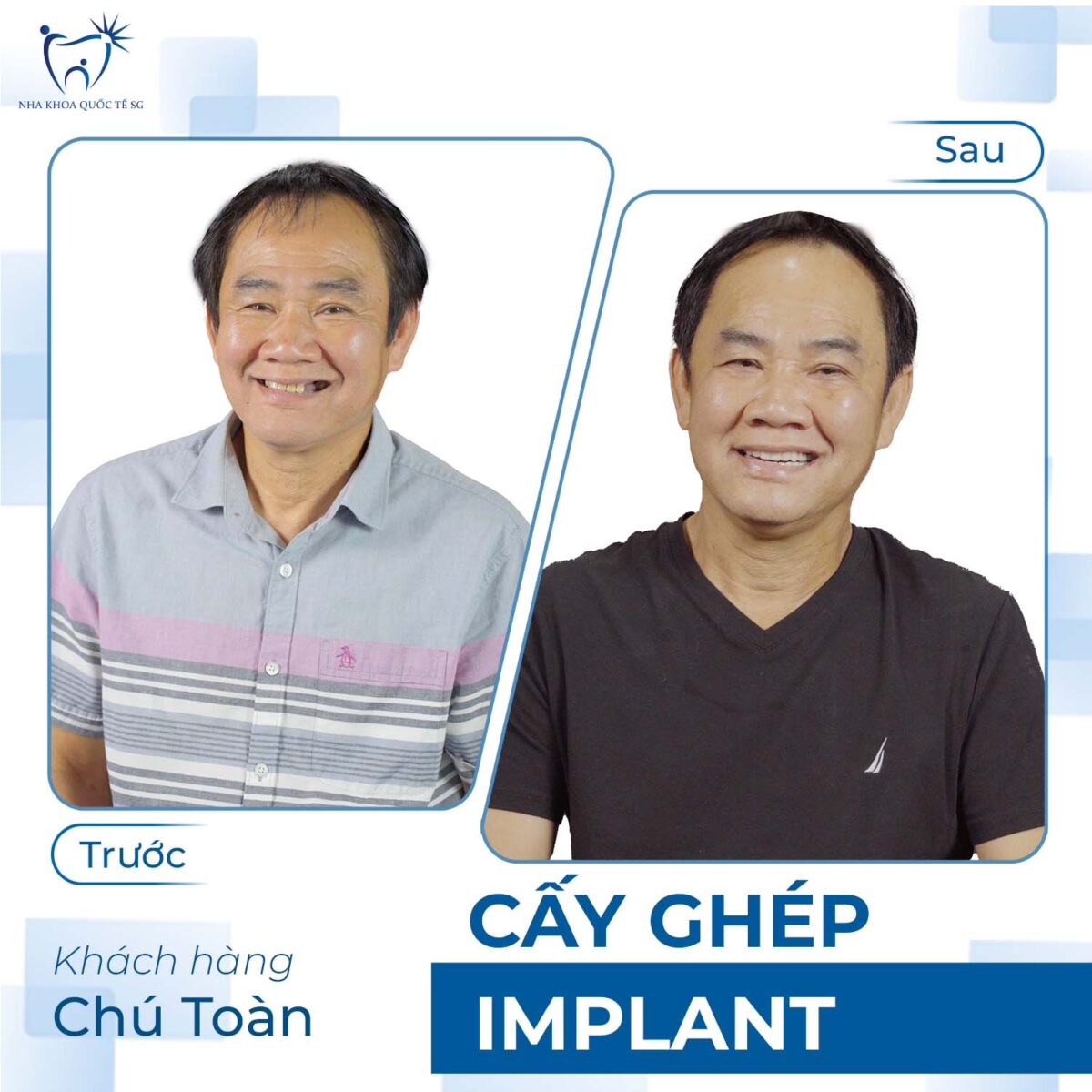 Chú toàn trước và sau khi thực hiện cấy ghép Implant tại Nha Khoa Quốc Tế SG