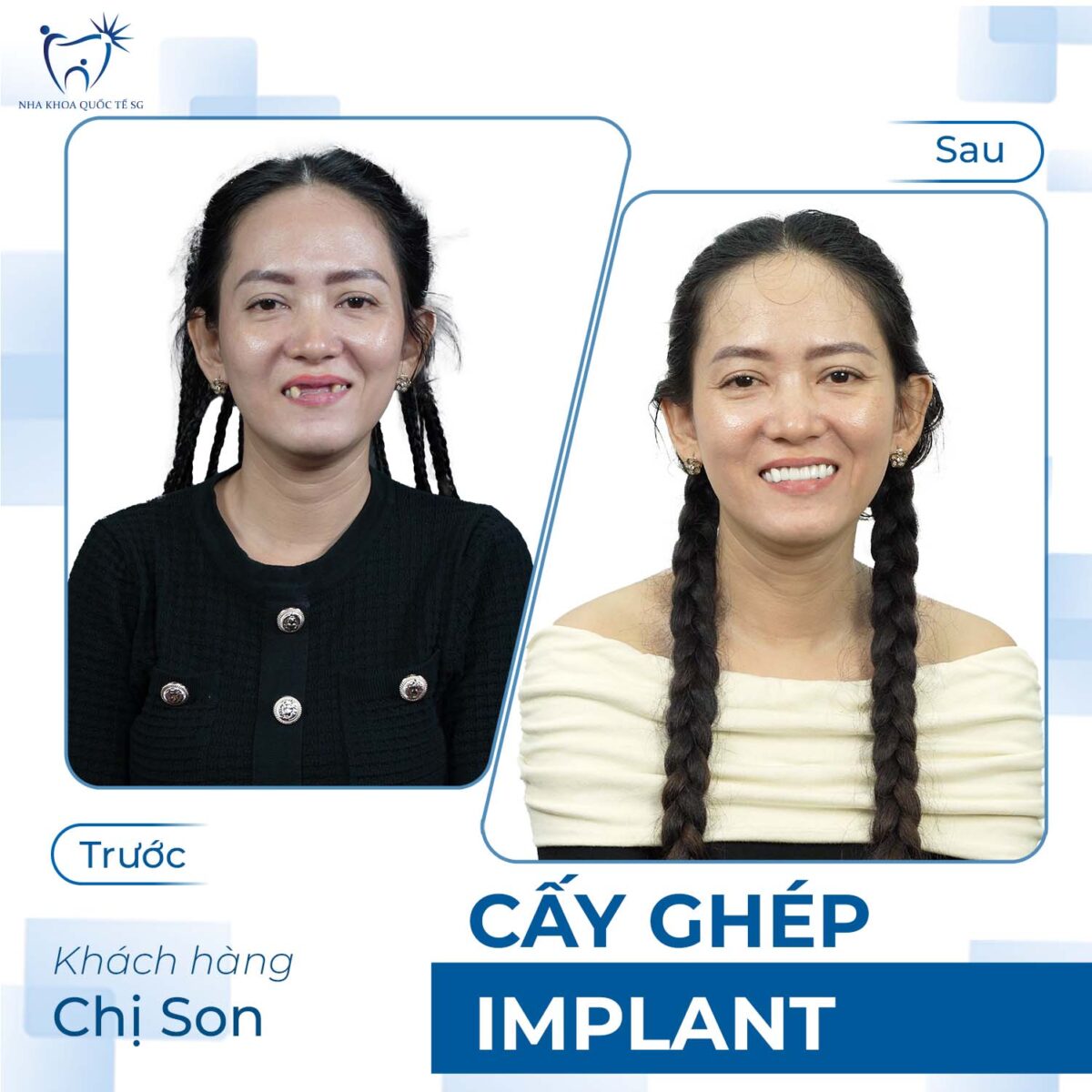 chị son trước và sau khi thực hiện cấy ghép Implant tại Nha Khoa Quốc Tế SG
