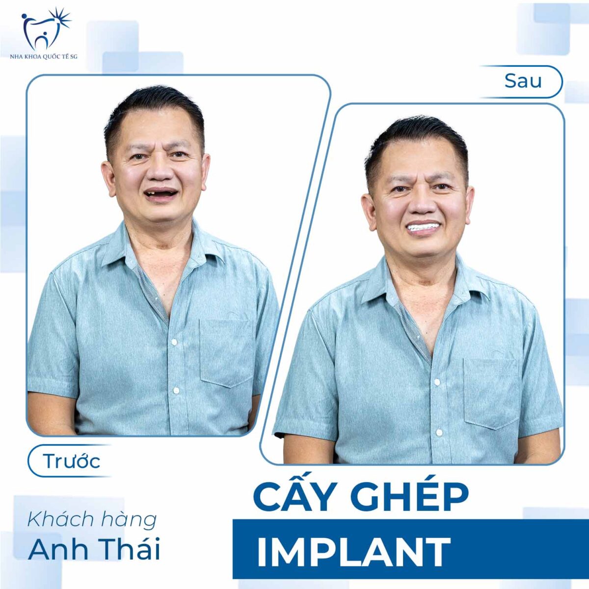 anh thái trước và sau khi thực hiện cấy ghép Implant tại Nha Khoa Quốc Tế SG