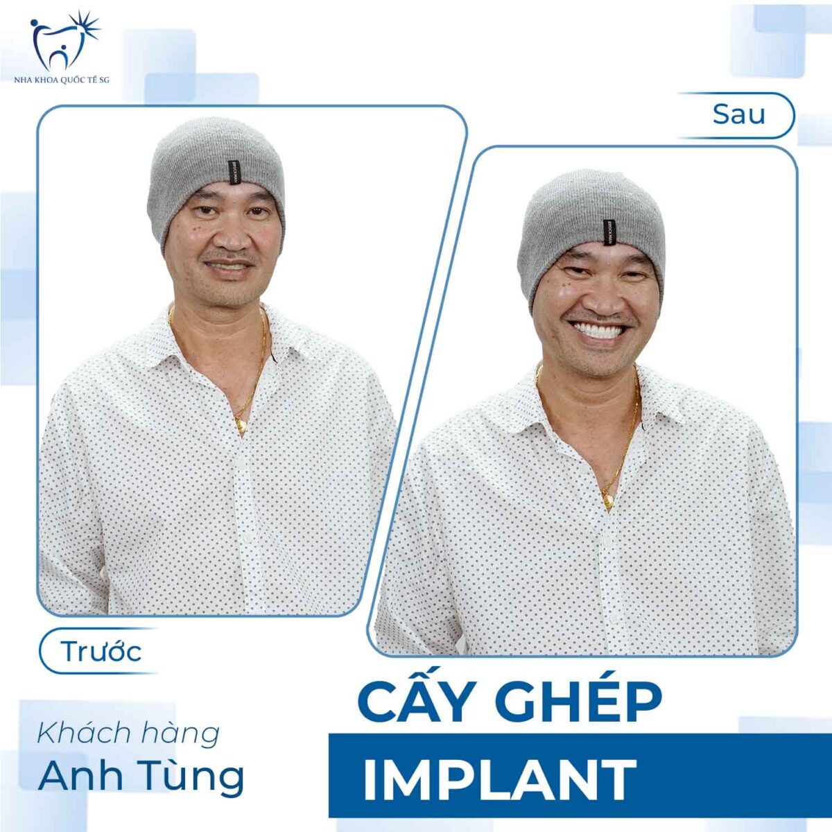 anh Tùng trước và sau khi thực hiện cấy ghép Implant tại Nha Khoa Quốc Tế SG