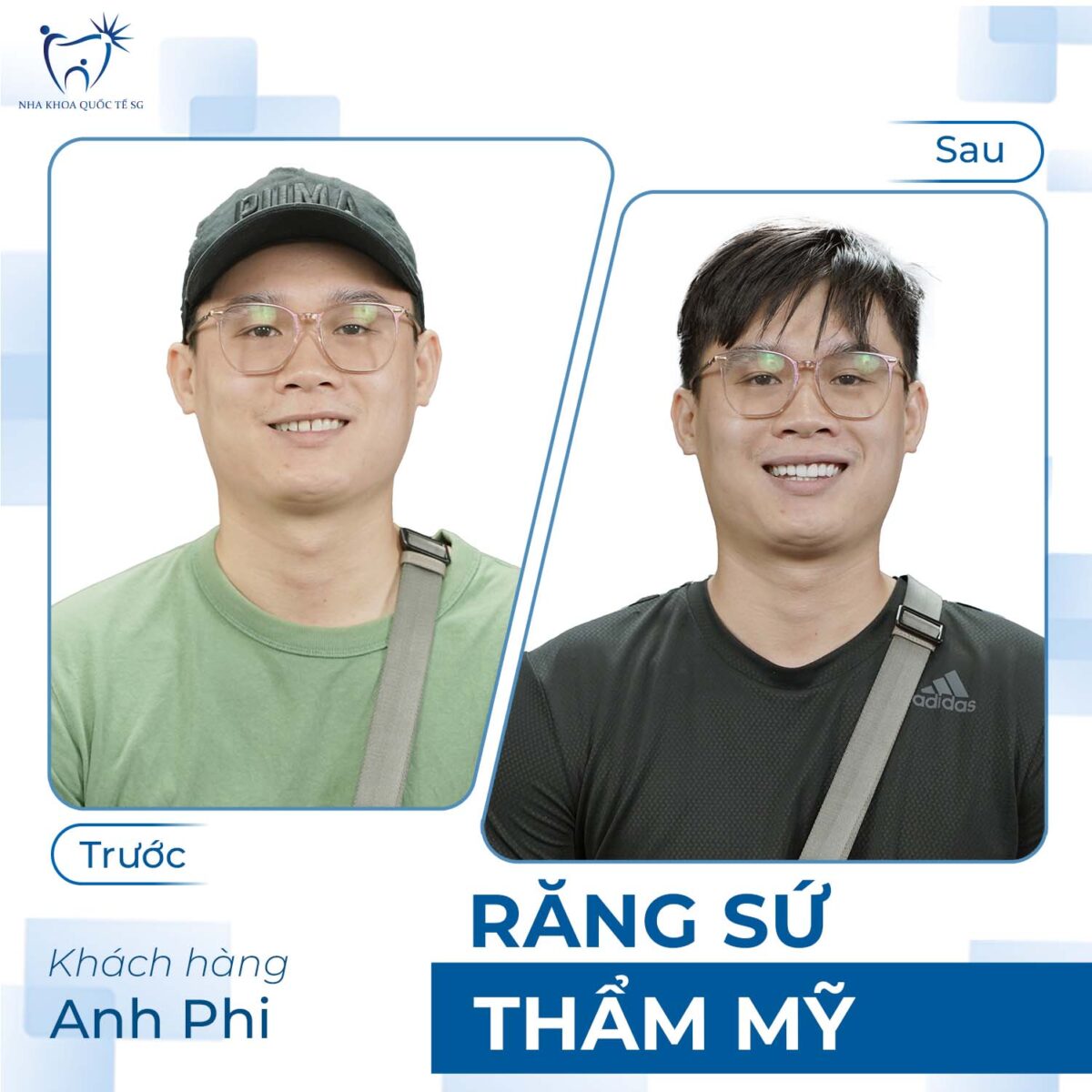 anh Phi trước và sau khi thực hiện bọc sứ thẩm mỹ tại Nha Khoa Quốc Tế SG