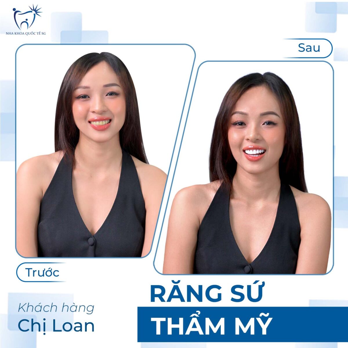 Chị Loan trước và sau khi thực hiện bọc sứ thẩm mỹ tại Nha Khoa Quốc Tế SG