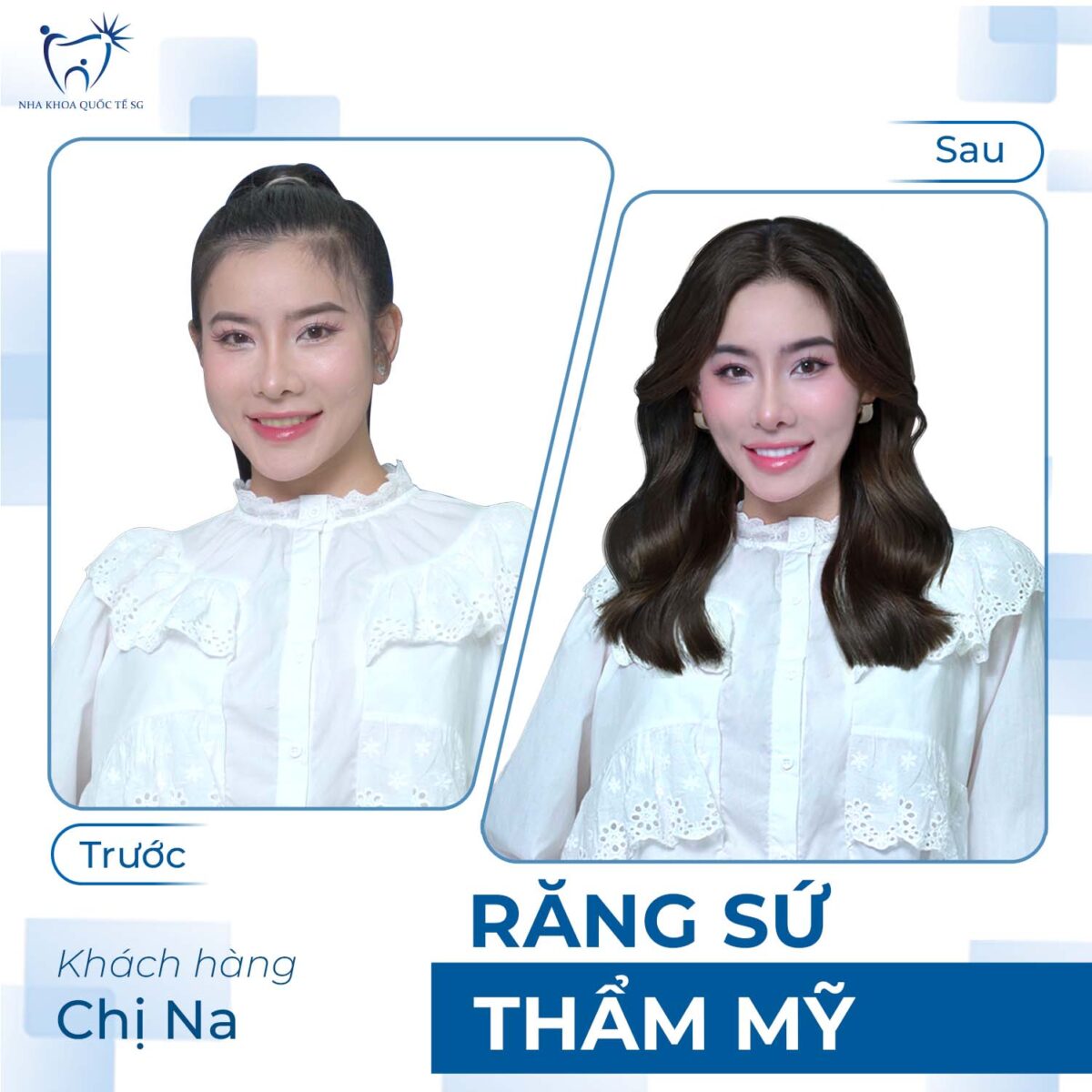 Chị Na trước và sau khi thực hiện bọc sứ thẩm mỹ tại Nha Khoa Quốc Tế SG