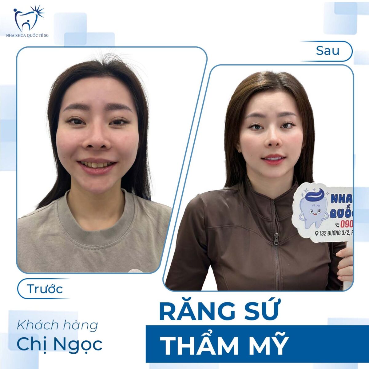 Chị Ngọc trước và sau khi thực hiện bọc sứ thẩm mỹ tại Nha Khoa Quốc Tế SG