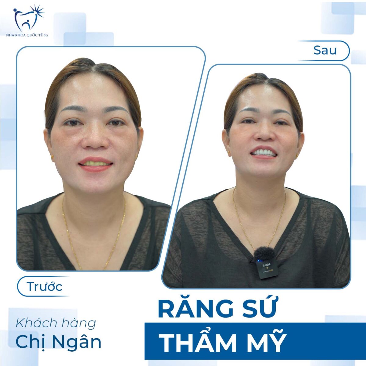 Chị Ngân trước và sau khi thực hiện bọc sứ thẩm mỹ tại Nha Khoa Quốc Tế SG