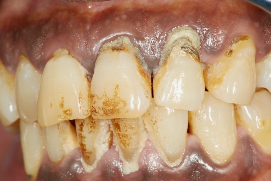 Tình trạng răng bị viêm nha chu nặng