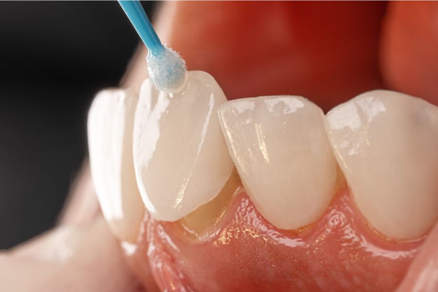 Nha Khoa Quốc Tế Sài Gòn Thực hiện dán sứ Veneer lên răng thật