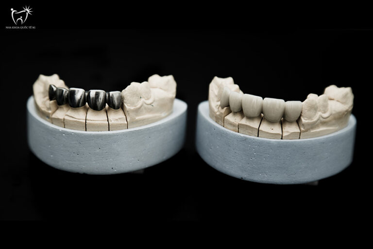 Nha Khoa Quốc Tế Sài Gòn Có nhiều loại răng sứ Titan hiện nay