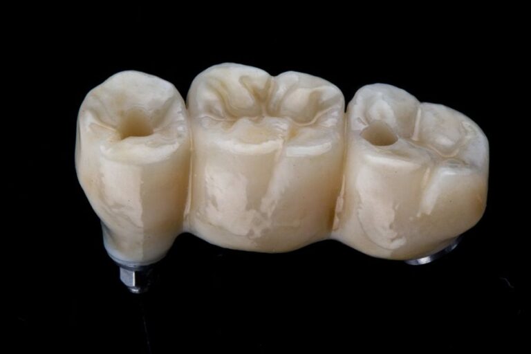 Nha Khoa Quốc Tế Sài Gòn Cầu răng sứ Titan có hợp kim làm từ Titan