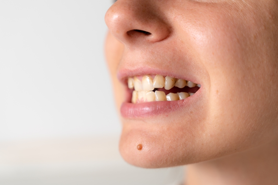 Nha Khoa Quốc Tế Sài Gòn Trường hợp răng khấp khểnh nhẹ có thể dán sứ Veneer